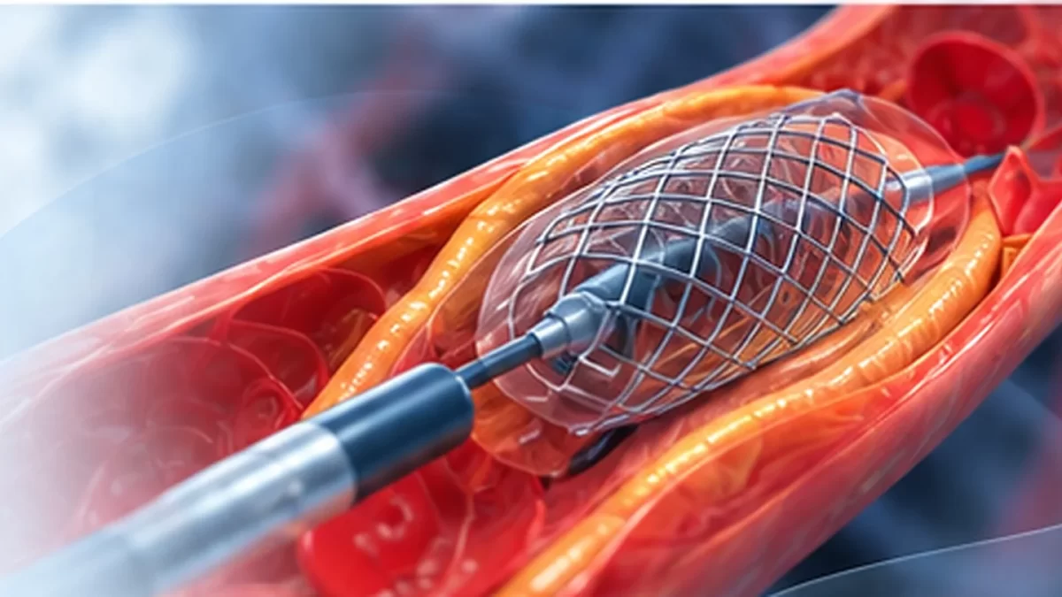 Chirurgie endovasculară – stent vascular