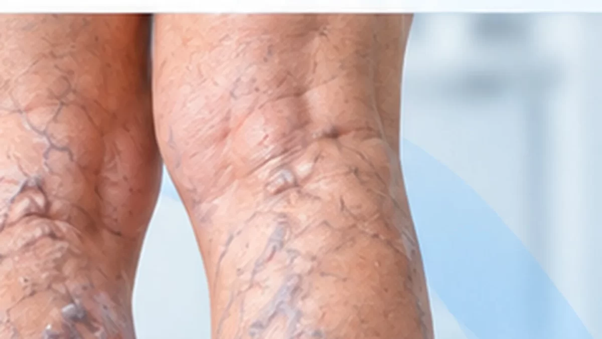 Varice și insuficiență venoasă – chirurgie vasculară